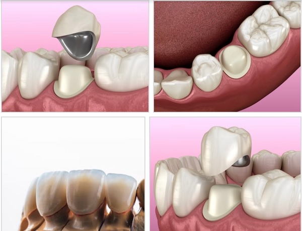 răng sứ titan có bị đen không