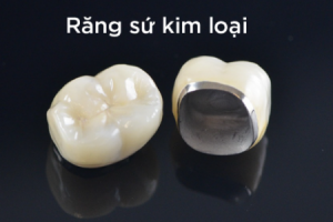 răng sứ kim loại là gì